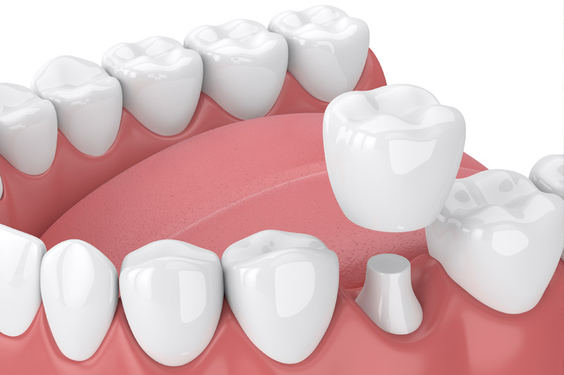 Dental Crowns in Evanston