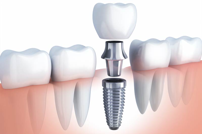 Implants Dentist in Evanston