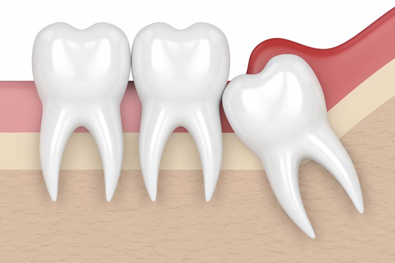 Wisdom Tooth Removal in Evanston